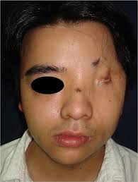 A 24-year-old male presents with a Tessier 10 cleft, eyelid deformity,...