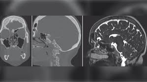 Nasal polyps (np) are noncancerous growths within the nose or sinuses. Woman With Skull Defect Leaks Cerebrospinal Fluid From Her Nose After A Nasal Swab Covid 19 Test Ctv News