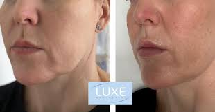 Non surgical facelift! PROFHILO STRUCTURA!! This is the results after only  ONE treatment! Profhilo Structura is a hyaluronic acid injectable gel that  helps restore facial volume and contours, and improve skin quality.