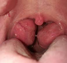 Image result for Tonsillectomy