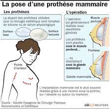 Vous aurez besoin d'une prothèse mammaire partielle dans le cas de : Les Implants Mammaires Textures Favoriseraient Une Forme Rare De Cancer