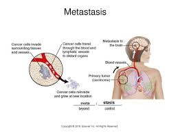 (esp of cancer cells ) to spread to a new site in the body via blood or lymph vessels | meaning, pronunciation, translations and examples Body Structure Color And Oncology Ppt Download