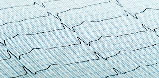 Jika anda merasa degupan jantung anda sering berdegup dengan laju dan perlahan dalam masa yang singkat, anda mungkin mengalami gejala penyakit arrhythmia. Jantung Berdebar Tanpa Sebab Ini Mungkin 4 Punca Di Sebaliknya