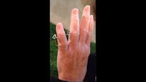 The splint is usually worn for three weeks while the bone heals. Broken Finger Healed Youtube