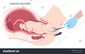 Image result for Forceps Assisted Delivery