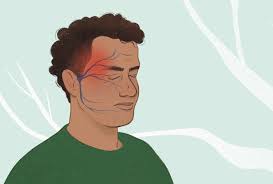 Image result for Acute Localized Headache