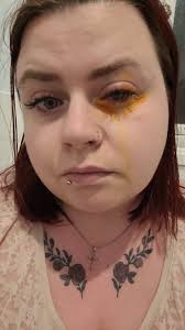 Im very accident prone its ridiculous. This was the time i sliced inside my  eye with a birthday card 🙃 3 years