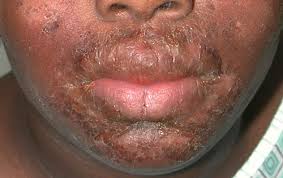 Image result for yellow scabs on the face in children