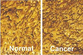 Maybe you would like to learn more about one of these? Detecting Bladder Cancer With Atomic Force Microscopy Healthcare In Europe Com