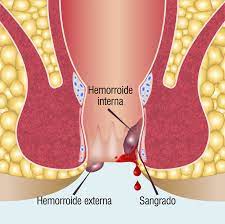 Hemorroides Que Son Sintomas Y Tratamientos