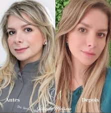 Listen to music from rick e renner acústico. Dra Isrraela Massena Referencia Em Harmonizacao Facial Conhece Por Experiencia Propria Os Danos Causados Pela Baixa Autoestima Super Radio Tupi