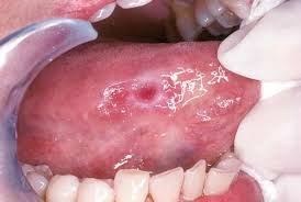 Image result for white cancer on tongue)