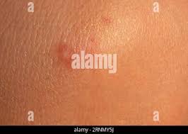 Image result for spinne biss haut reaktion