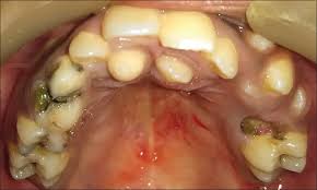 Displacement of the adjacent teeth, delayed eruption of the permanent teeth, median diastema or cystic changes around the unerupted supernumerary tooth,. Double Mesiodens In Mixed Dentition Period Report Of 3 Cases Rana Ss Ohri N Srm J Res Dent Sci
