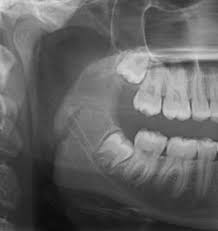 You can be awake during your wisdom teeth removal. Wisdom Teeth Faq Calgary Ab Foundation Oral Surgery