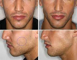 Las personas con cara redonda o que están inconformes con los cachetes. Bichectomia Hombres Antes Y Despues