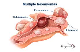 When diagnosed early, most cases of endometrial cancer can be treated successfully. Center For Menstrual Disorders In Rochester Ny
