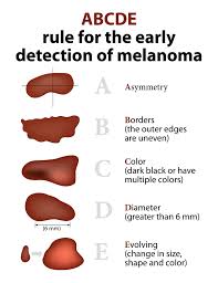 Knowing which one you have will inform your doctor's treatment recommendations. Tips For Early Detection Of Melanoma Postindependent Com
