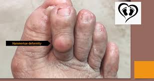 Image result for Hammer toe