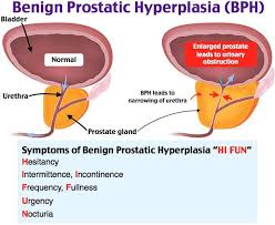 Benign Prostatic Hyperplasia Bph Rosh Review Benign Prostatic Hyperplasia Nurse Training Neonatal Nurse