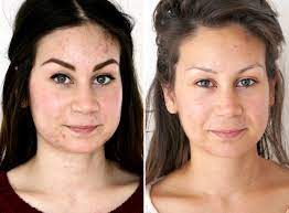 Op deze site houd ik me, zolang er nog geen gangbare nederlandse term is, aan de engelse afkorting. Laatste Fase Acne Behandeling Beautylab Nl