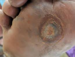 Icd 10 code diabetic foot ulcer wound. Diabetic Foot Ulcer Dermnet Nz
