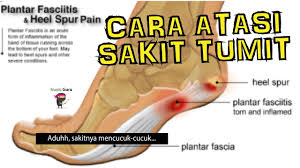 Antara punca sakit tumit kaki adalah kerana tekanan yang berlebihan, keradangan pada lapisan lemak di tumit dan ketumbuhan spur atau tulang kecil di tumit. Cara Berkesan Mengatasi Sakit Tumit Kaki Yang Ramai Orang Tak Tahu Sub Youtube