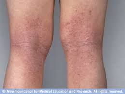 شرح مصور عن اسباب الطفح الجلدي الشائعة ويب طب