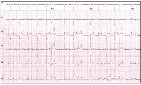 Experts aren't sure what causes the extra beat known as pvc. Cardiac Arrhythmia With Premature Ventricular Contractures Induced By Interferon Beta In A Patient With Multiple Sclerosis