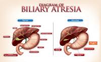 Type, application and key companies. Biliary Atresia