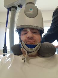 Experiences with TMS therapy?