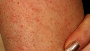 Red dots on legs usually occur as a symptom of some other mild or severe underlying condition. What Are Those Red Spots On Your Arms And Legs Red Skin Spots Red Spots On Legs Keratosis Pilaris