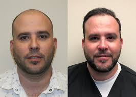 Best Hair Loss Treatment For Men And Women in Texas Hidalgo Carlos G Leal  Junior Colonia Number 2