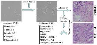 Charles patrick davis, md, phd. Galectin 1 Expression In Activated Pancreatic Satellite Cells Promotes Fibrosis In Chronic Pancreatitis Pancreatic Cancer Via The Tgf B1 Smad Pathway
