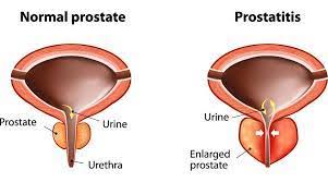 Image result for Prostatitis General Measures