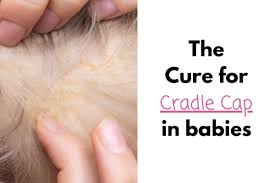 Let it soak into the scales for a few minutes, or hours if needed. Cradle Cap The Best Way To Get Rid Of It Diary Of A So Cal Mama