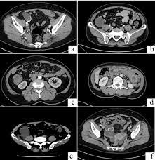 Management And Prognosis Of Low Grade Appendiceal Mucinous Neoplasms A Clinicopathologic Analysis Of 50 Cases Sciencedirect