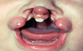 Image result for Neonatal Teeth