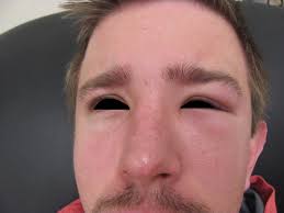 Morbihan disease (md) is a rare entity. Successful Treatment Of Solid Persistent Facial Edema With Isotretinoin And Compression Therapy Jaad Case Reports