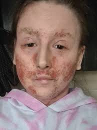 Image result for ekzema face