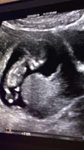 Ecografia Ultrasonido 11 Semanas 6 Club Septiembre 2019 Embarazo Y Bebes Babycenter
