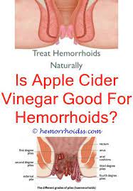 Is Colonoscopy Necessary For External Hemorrhoid Removal How Do Hemorrhoids Get Better How Do You If Y Hemorrhoids Treatment Cure For Hemorrhoids Hemorrhoids