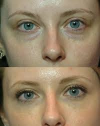 Biossance Squalane Peptide Eye Gel Before And After Face Reflexology For Reducing Black Circles Eye Lines And Swollen Eye Bags Eye Bags Under Eye Hollows Cure Puffy Eyes