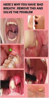 Wash your mouth out with saltwater or water rinse. Tonsil Stone Removal