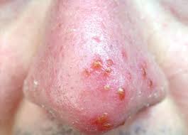 Image result for Pemphigus