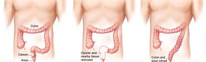 The colon (:) marks a bigger pause than that is expressed by the semicolon. Colon Cancer Can Be Defeated With Minimally Invasive Laparoscopic Surgery Prime Surgicare