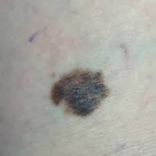 Some look like irregular moles but not all. Melanoma Pictures Example Pictures Of Melanoma Symptoms