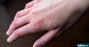 Coconut oil and oatmeal for eczema: How Apple Cider Vinegar Can Help Treat Your Eczema Helloderma Com