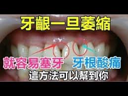 牙齦一旦萎縮 就容易 塞牙 牙根酸痛 這方法可以幫到你 很有效 health healthy tips youtube