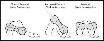 Image result for Femoral Retroversion